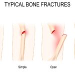 Broken Bones